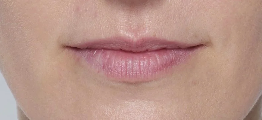 Before Restylane Kysse lip treatment — Galderma clinical image